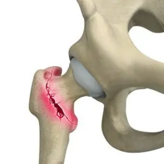 Hip Fractures